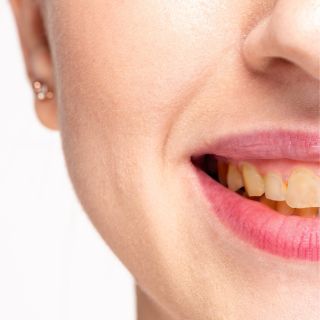 Rimozione delle macchie