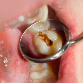 Prevenzione della formazione di macchie